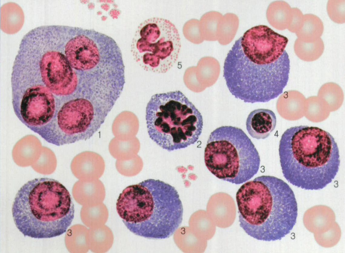 图261 多发性骨髓瘤(网状细胞型)骨髓象-血液学细胞学-医学